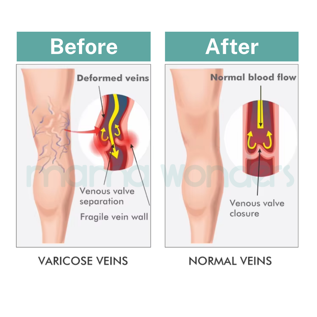 MamaRelief Open Toe Premium Compression Socks